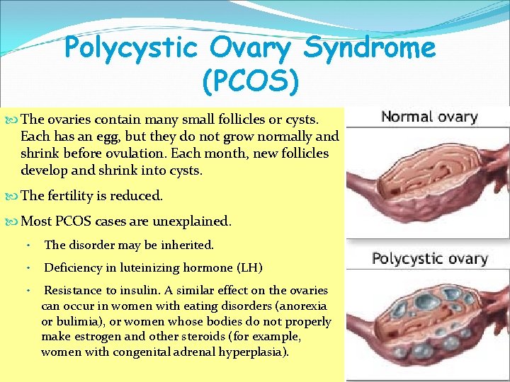 Polycystic Ovary Syndrome (PCOS) The ovaries contain many small follicles or cysts. Each has