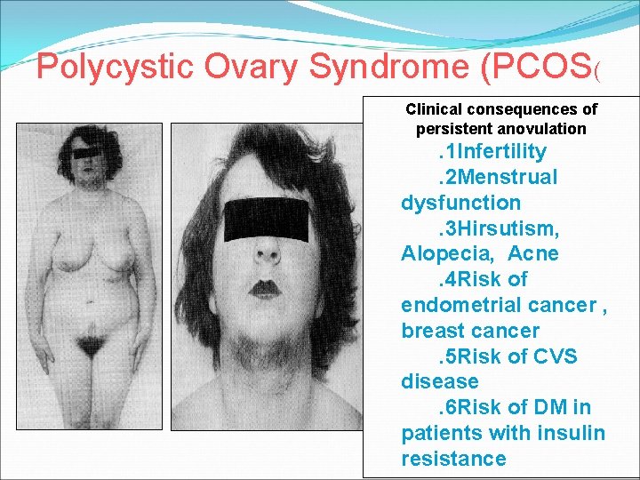Polycystic Ovary Syndrome (PCOS( Clinical consequences of persistent anovulation . 1 Infertility. 2 Menstrual