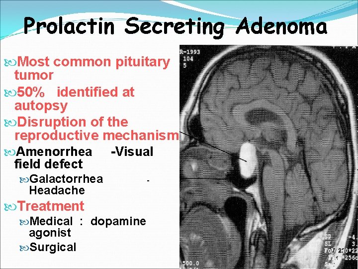 Prolactin Secreting Adenoma Most common pituitary tumor 50% identified at autopsy Disruption of the