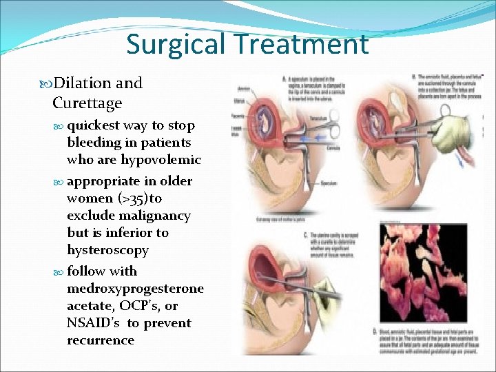 Surgical Treatment Dilation and Curettage quickest way to stop bleeding in patients who are