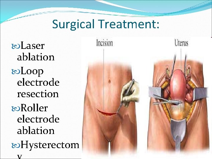 Surgical Treatment: Laser ablation Loop electrode resection Roller electrode ablation Hysterectom 