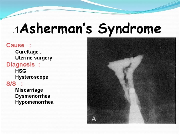 . 1 Asherman’s Syndrome Cause : Curettage , Uterine surgery Diagnosis : HSG Hysteroscope