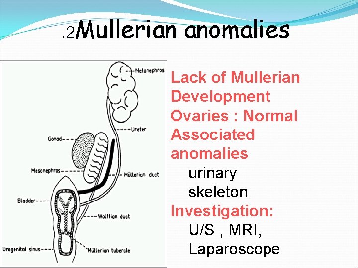 . 2 Mullerian anomalies Lack of Mullerian Development Ovaries : Normal Associated anomalies urinary