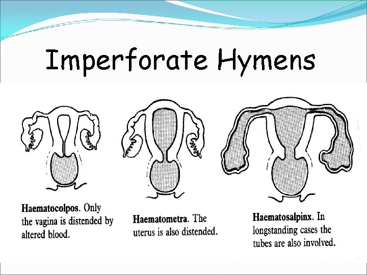 Imperforate Hymens 