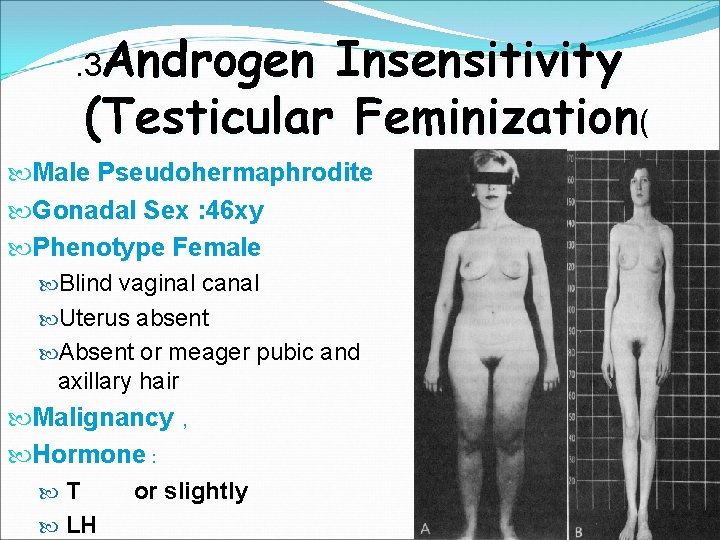 . 3 Androgen Insensitivity (Testicular Feminization( Male Pseudohermaphrodite Gonadal Sex : 46 xy Phenotype