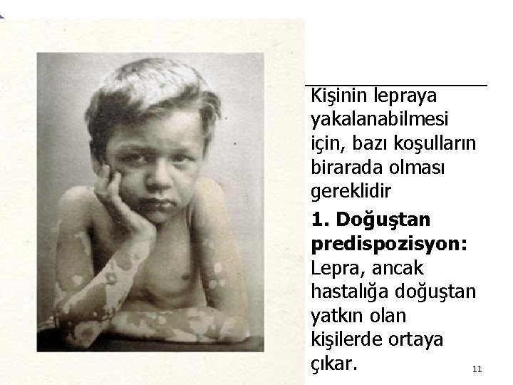 ¡ ¡ Kişinin lepraya yakalanabilmesi için, bazı koşulların birarada olması gereklidir 1. Doğuştan predispozisyon:
