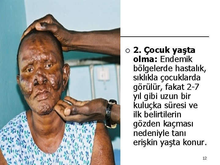 ¡ 2. Çocuk yaşta olma: Endemik bölgelerde hastalık, sıklıkla çocuklarda görülür, fakat 2 -7