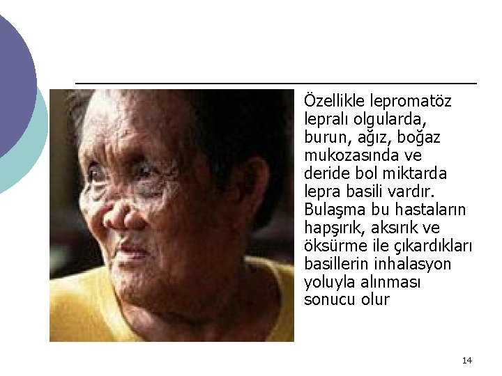 ¡ Özellikle lepromatöz lepralı olgularda, burun, ağız, boğaz mukozasında ve deride bol miktarda lepra