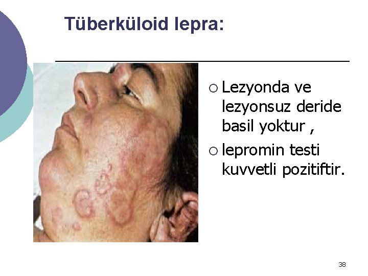 Tüberküloid lepra: ¡ Lezyonda ve lezyonsuz deride basil yoktur , ¡ lepromin testi kuvvetli