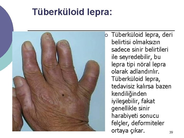 Tüberküloid lepra: ¡ Tüberküloid lepra, deri belirtisi olmaksızın sadece sinir belirtileri ile seyredebilir, bu