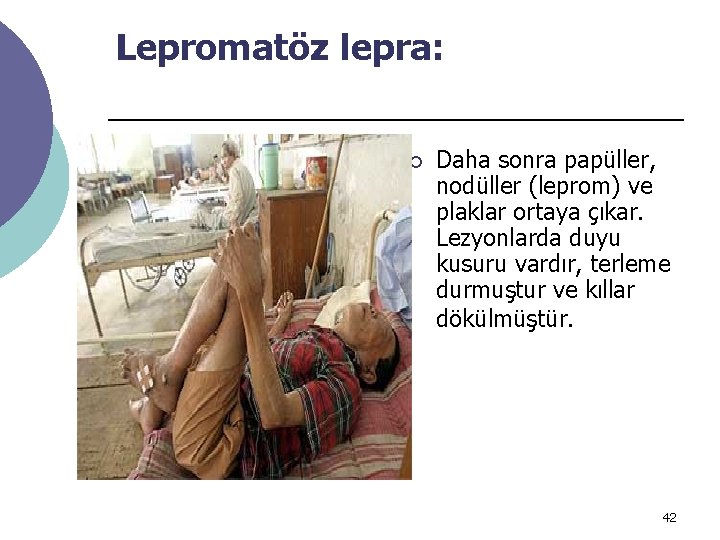 Lepromatöz lepra: ¡ Daha sonra papüller, nodüller (leprom) ve plaklar ortaya çıkar. Lezyonlarda duyu