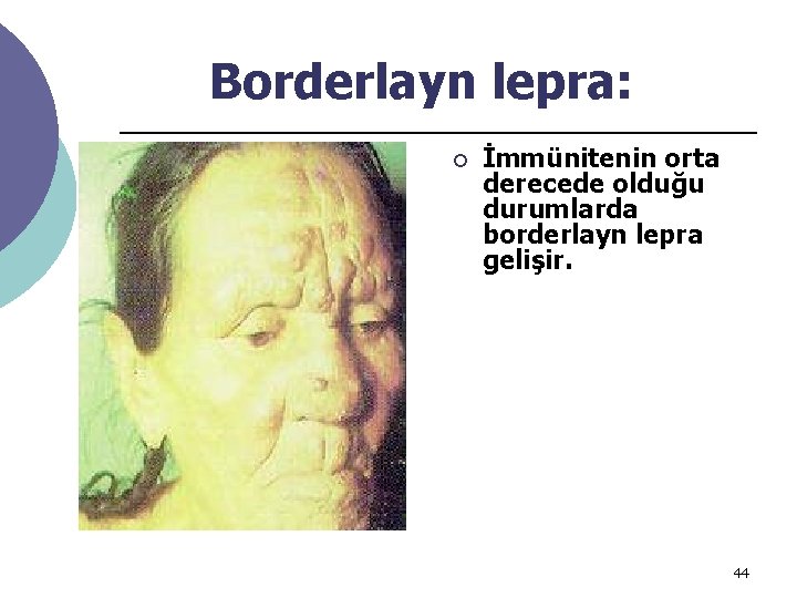Borderlayn lepra: ¡ İmmünitenin orta derecede olduğu durumlarda borderlayn lepra gelişir. 44 