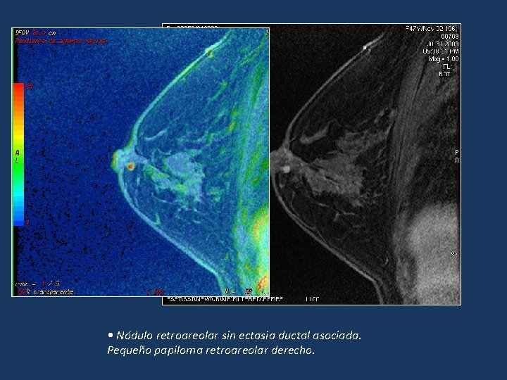 • Nódulo retroareolar sin ectasia ductal asociada. Pequeño papiloma retroareolar derecho. • Nódulo retroareolar sin ectasia ductal asociada. Pequeño papiloma retroareolar derecho.