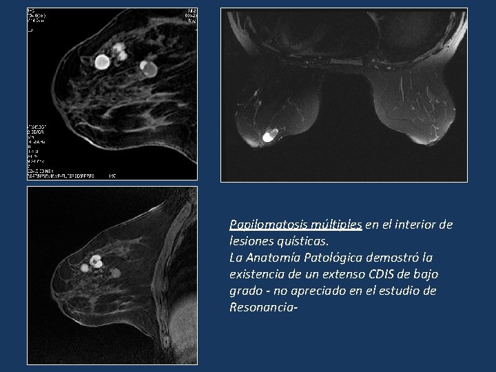 Papilomatosis múltiples en el interior de lesiones quísticas. La Anatomía Patológica demostró la existencia Papilomatosis múltiples en el interior de lesiones quísticas. La Anatomía Patológica demostró la existencia