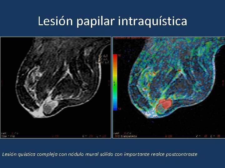Lesión papilar intraquística Lesión quística compleja con nódulo mural sólido con importante realce postcontraste Lesión papilar intraquística Lesión quística compleja con nódulo mural sólido con importante realce postcontraste