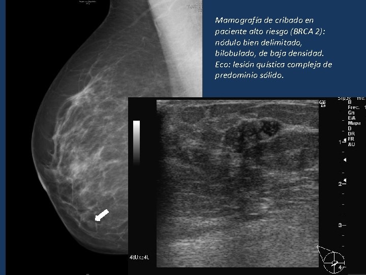 Mamografía de cribado en paciente alto riesgo (BRCA 2): nódulo bien delimitado, bilobulado, de Mamografía de cribado en paciente alto riesgo (BRCA 2): nódulo bien delimitado, bilobulado, de