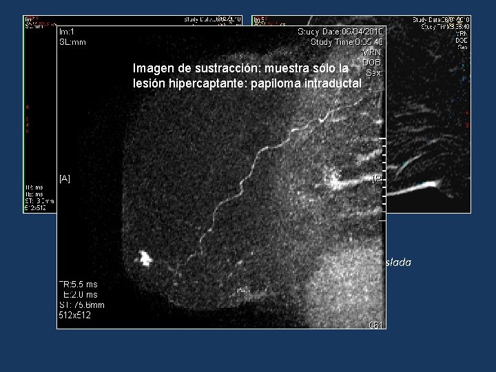 Imagen de sustracción: muestra sólo la lesión hipercaptante: papiloma intraductal RM del caso anterior: Imagen de sustracción: muestra sólo la lesión hipercaptante: papiloma intraductal RM del caso anterior: