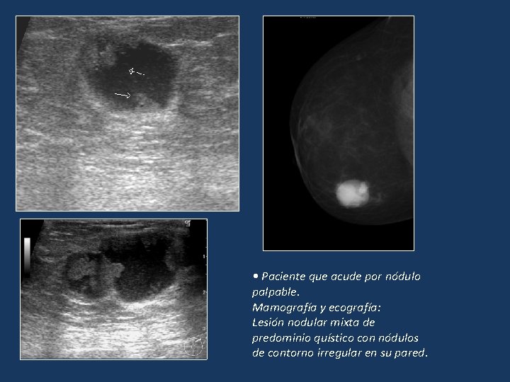 • Paciente que acude por nódulo palpable. Mamografía y ecografía: Lesión nodular mixta • Paciente que acude por nódulo palpable. Mamografía y ecografía: Lesión nodular mixta