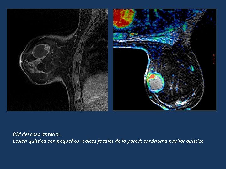 RM del caso anterior. Lesión quística con pequeños realces focales de la pared: carcinoma RM del caso anterior. Lesión quística con pequeños realces focales de la pared: carcinoma