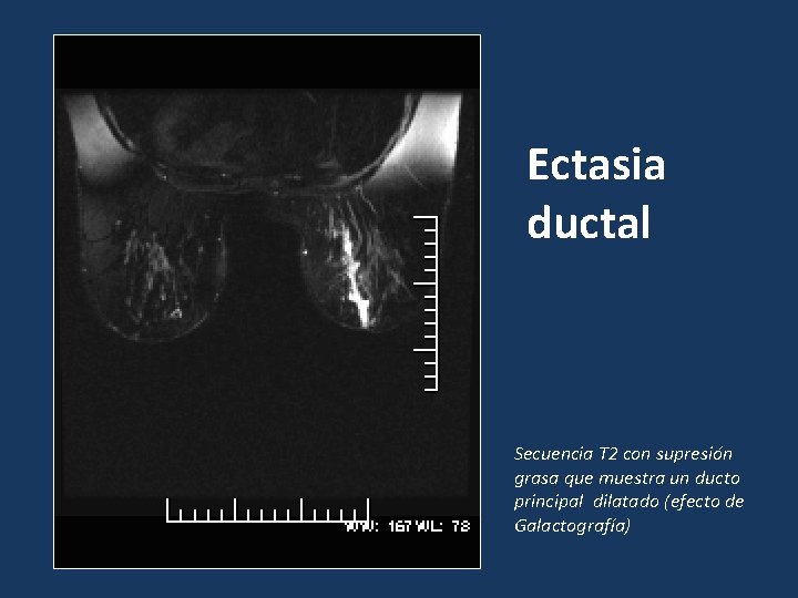 Ectasia ductal Secuencia T 2 con supresión grasa que muestra un ducto principal dilatado Ectasia ductal Secuencia T 2 con supresión grasa que muestra un ducto principal dilatado