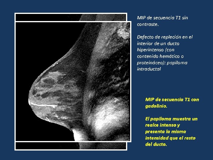 MIP de secuencia T 1 sin contraste. Defecto de repleción en el interior de MIP de secuencia T 1 sin contraste. Defecto de repleción en el interior de