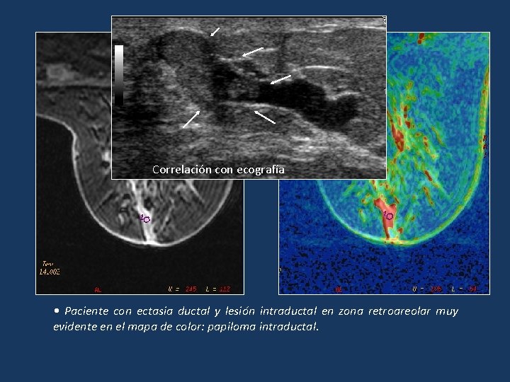 Cancerul la sân: cum poate fi diagnosticat şi tratat - Papiloma intraductal ecografia