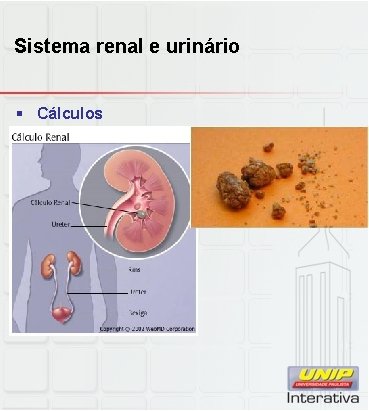 Sistema renal e urinário § Cálculos 