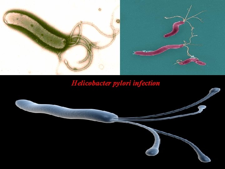Helicobacter pylori infection 