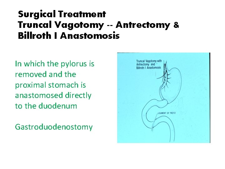 Surgical Treatment Truncal Vagotomy -- Antrectomy & Billroth I Anastomosis In which the pylorus
