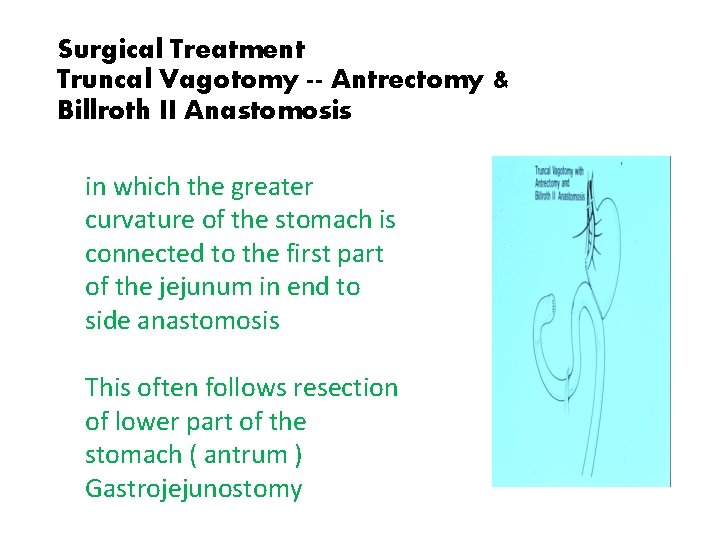 Surgical Treatment Truncal Vagotomy -- Antrectomy & Billroth II Anastomosis in which the greater