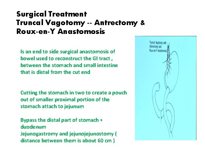 Surgical Treatment Truncal Vagotomy -- Antrectomy & Roux-en-Y Anastomosis Is an end to side