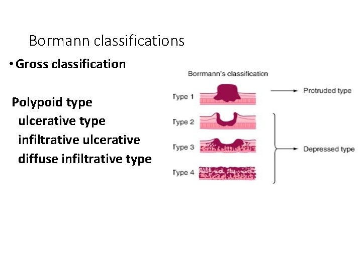 Bormann classifications • Gross classification Polypoid type ulcerative type infiltrative ulcerative diffuse infiltrative type