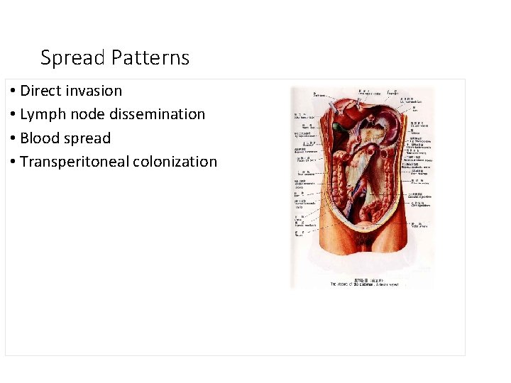 Spread Patterns • Direct invasion • Lymph node dissemination • Blood spread • Transperitoneal