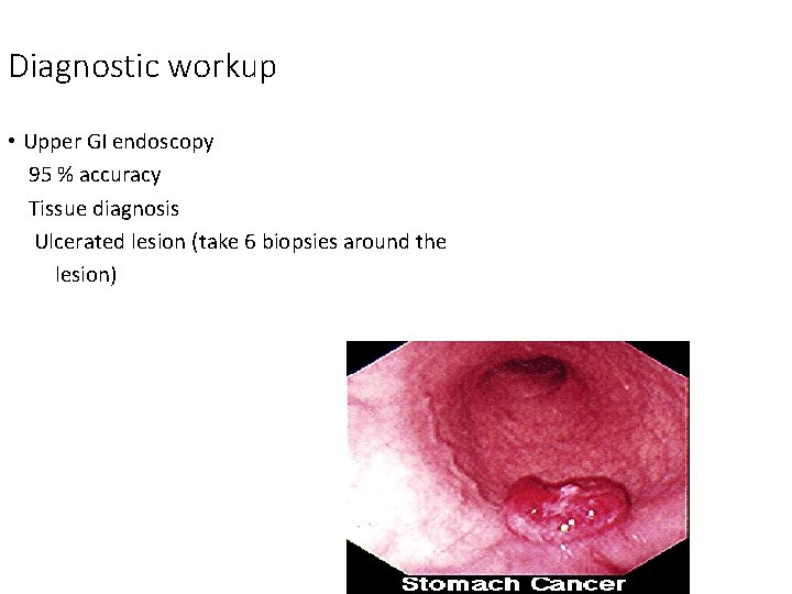 Diagnostic workup • Upper GI endoscopy 95 % accuracy Tissue diagnosis Ulcerated lesion (take