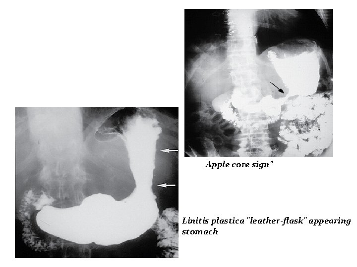 Apple core sign” Linitis plastica "leather-flask" appearing stomach 