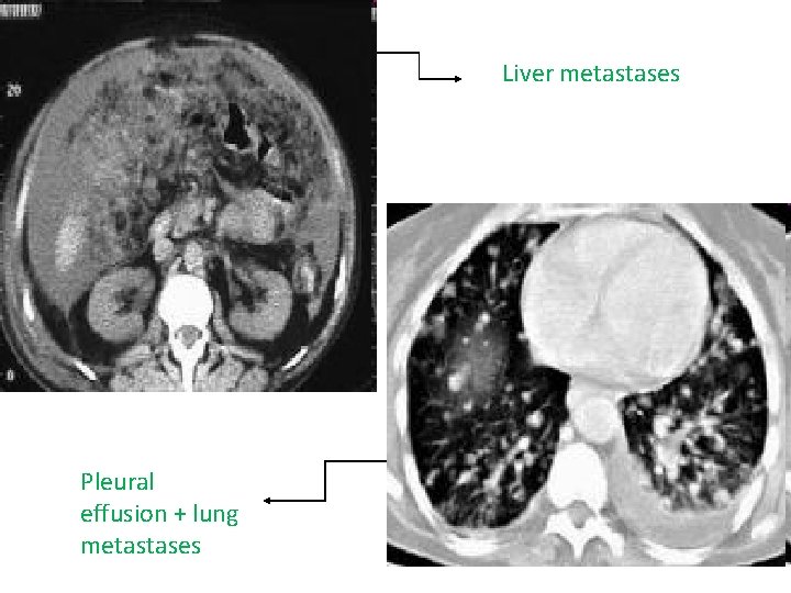 Liver metastases Pleural effusion + lung metastases 