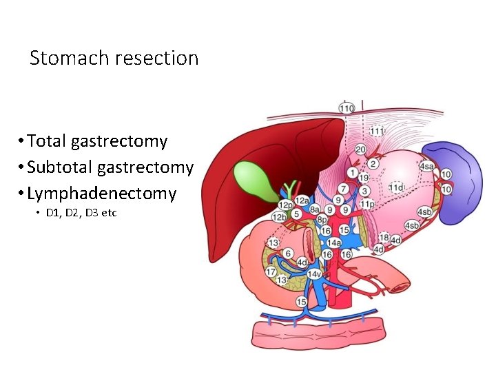 Stomach resection • Total gastrectomy • Subtotal gastrectomy • Lymphadenectomy • D 1, D