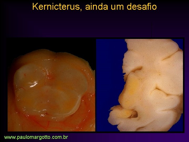 Kernicterus, ainda um desafio www. paulomargotto. com. br 
