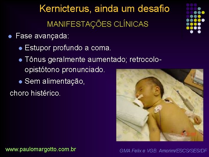 Kernicterus, ainda um desafio MANIFESTAÇÕES CLÍNICAS l Fase avançada: l Estupor profundo a coma.