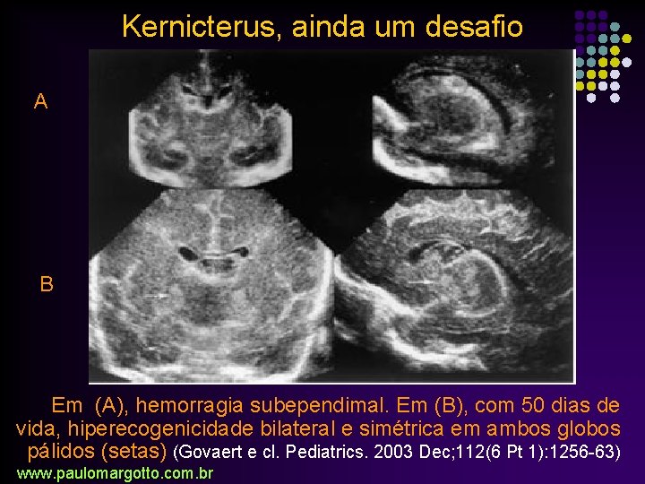 Kernicterus, ainda um desafio A B Em (A), hemorragia subependimal. Em (B), com 50