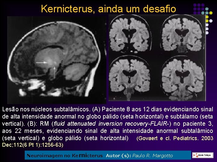 Kernicterus, ainda um desafio Lesão nos núcleos subtalâmicos. (A) Paciente 8 aos 12 dias