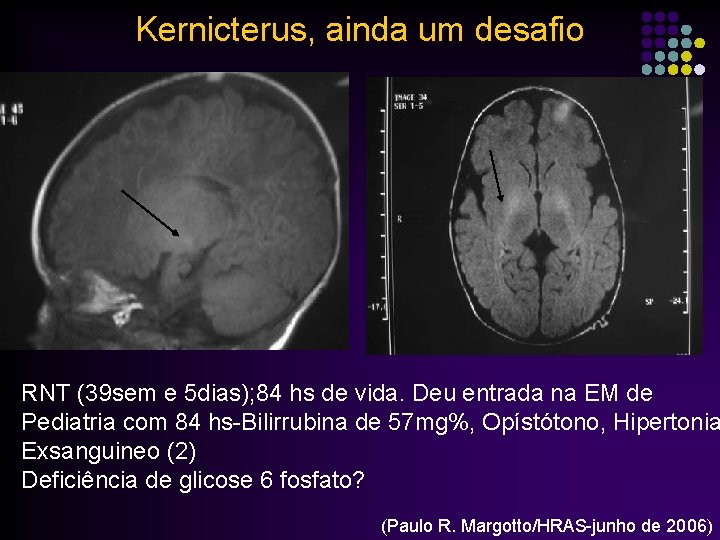 Kernicterus, ainda um desafio RNT (39 sem e 5 dias); 84 hs de vida.