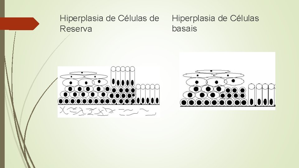 Hiperplasia de Células de Reserva Hiperplasia de Células basais 