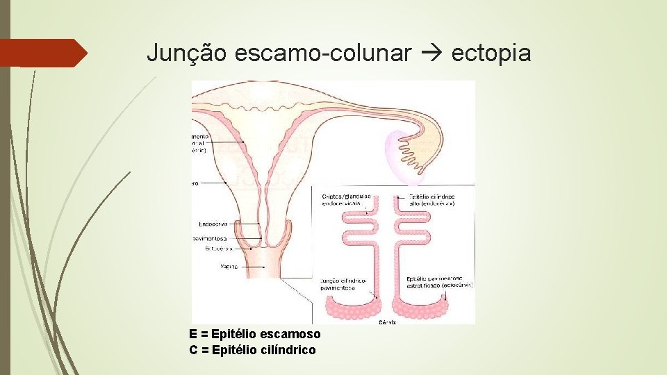 Junção escamo-colunar ectopia E = Epitélio escamoso C = Epitélio cilíndrico 