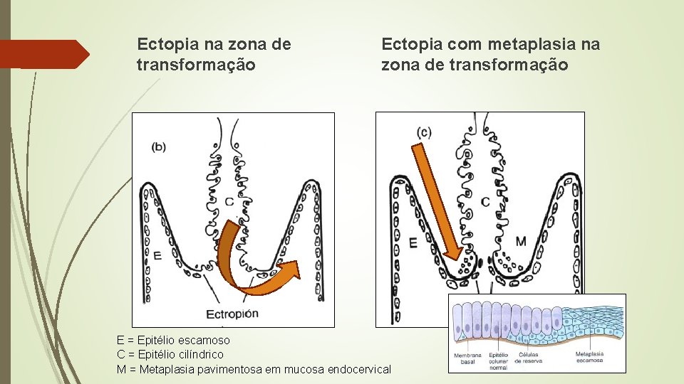 Ectopia na zona de transformação Ectopia com metaplasia na zona de transformação E =