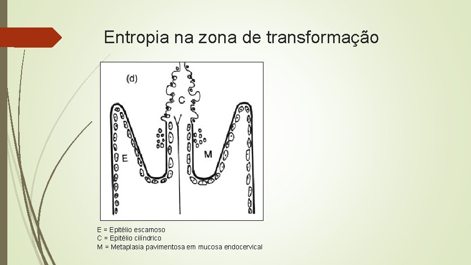 Entropia na zona de transformação E = Epitélio escamoso C = Epitélio cilíndrico M
