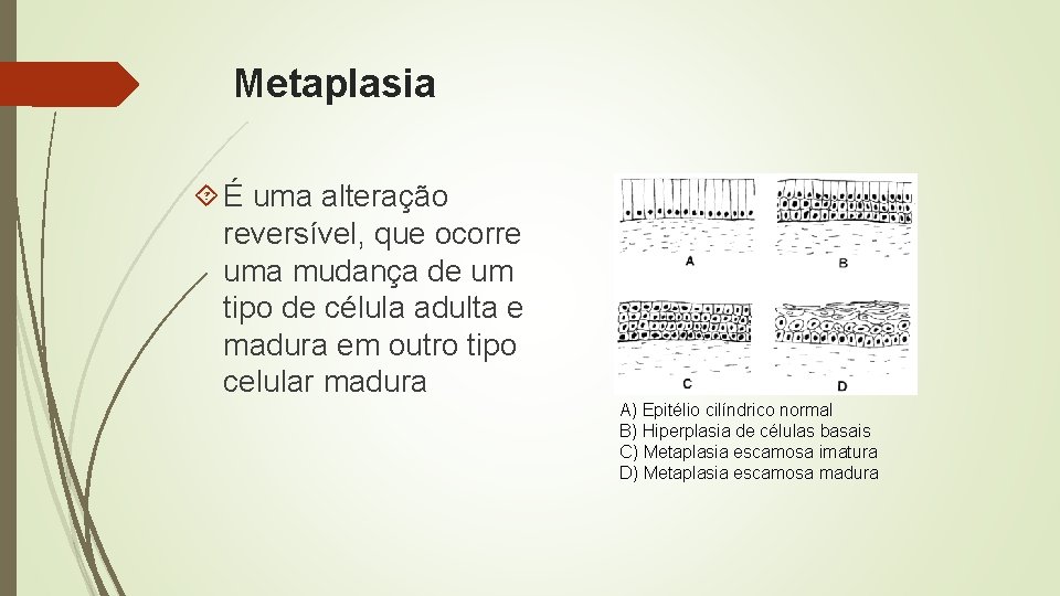 Metaplasia É uma alteração reversível, que ocorre uma mudança de um tipo de célula