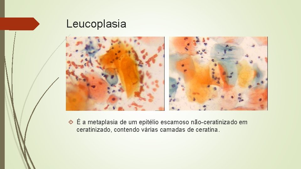Leucoplasia É a metaplasia de um epitélio escamoso não-ceratinizado em ceratinizado, contendo várias camadas