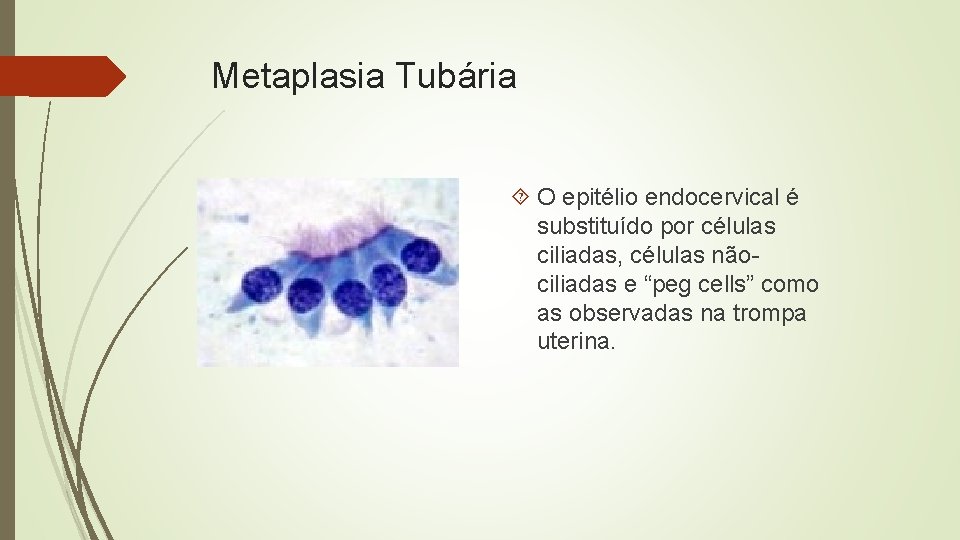 Metaplasia Tubária O epitélio endocervical é substituído por células ciliadas, células nãociliadas e “peg