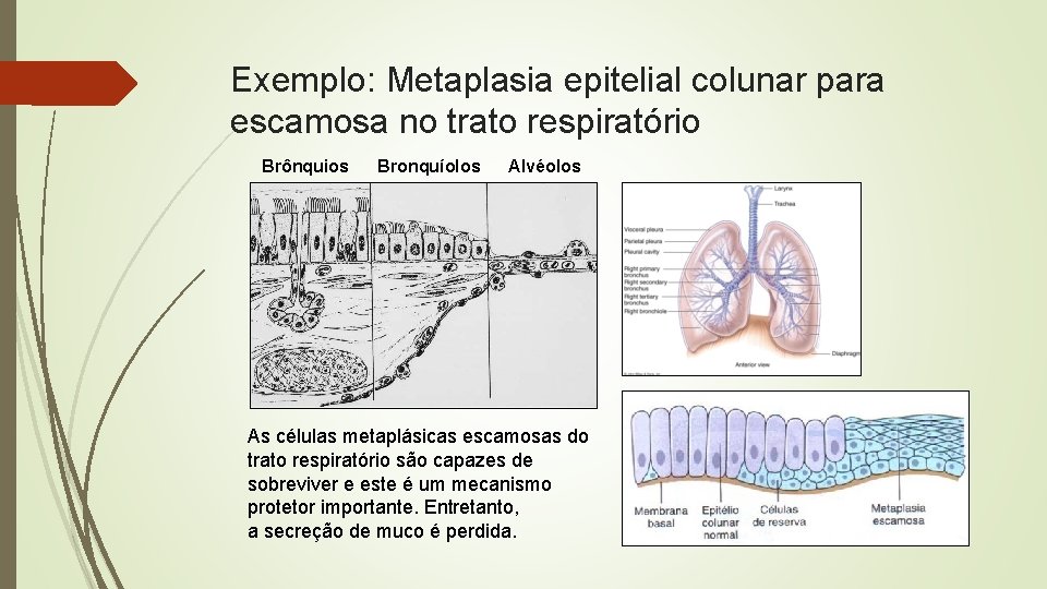 Exemplo: Metaplasia epitelial colunar para escamosa no trato respiratório Brônquios Bronquíolos Alvéolos As células